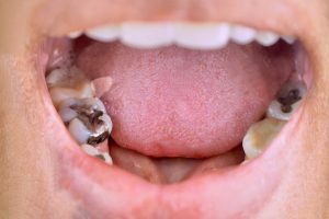 ignoring a tooth infection risks