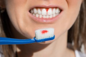 why do gums bleed when brushing