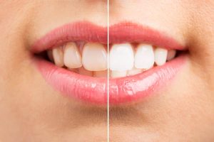 teeth whitening for coffee