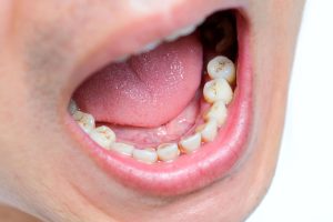 tooth decay early stages