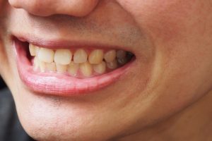 yellow teeth even after brushing