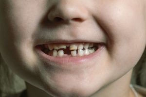 missing tooth on a child