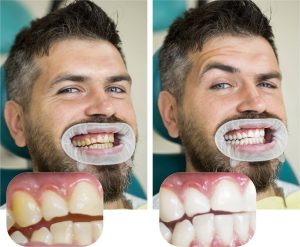 teeth whitening for severely yellow teeth