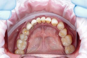 teeth deep stains